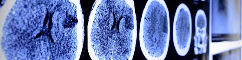 Lesiones Cerebrales Comunes en Casos De Accidentes